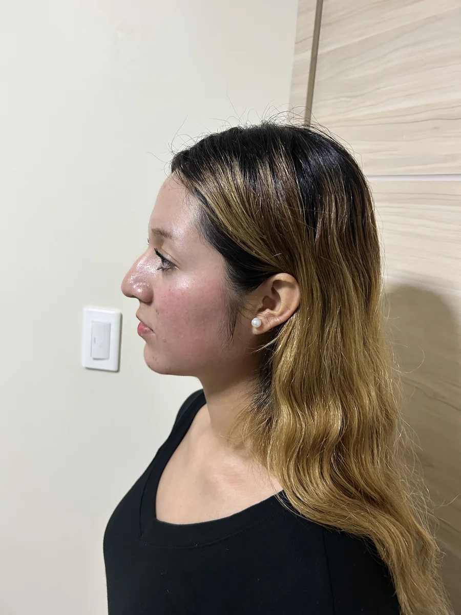 Caso 1, antes: perfil izquierdo